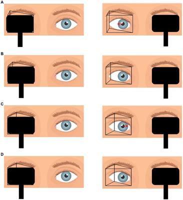 Effect of the prism and Maddox rod test as the surgical target for type III acute acquired comitant esotropia